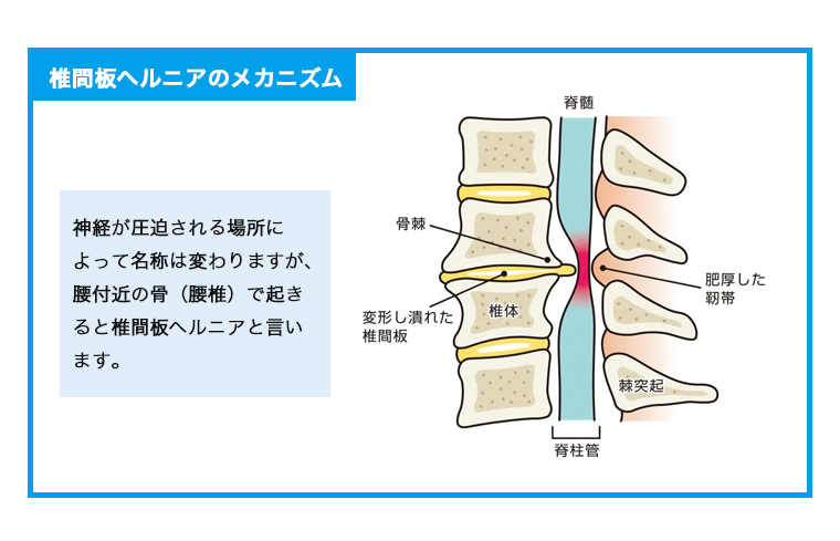 椎間板ヘルニアが起こる仕組みの図解