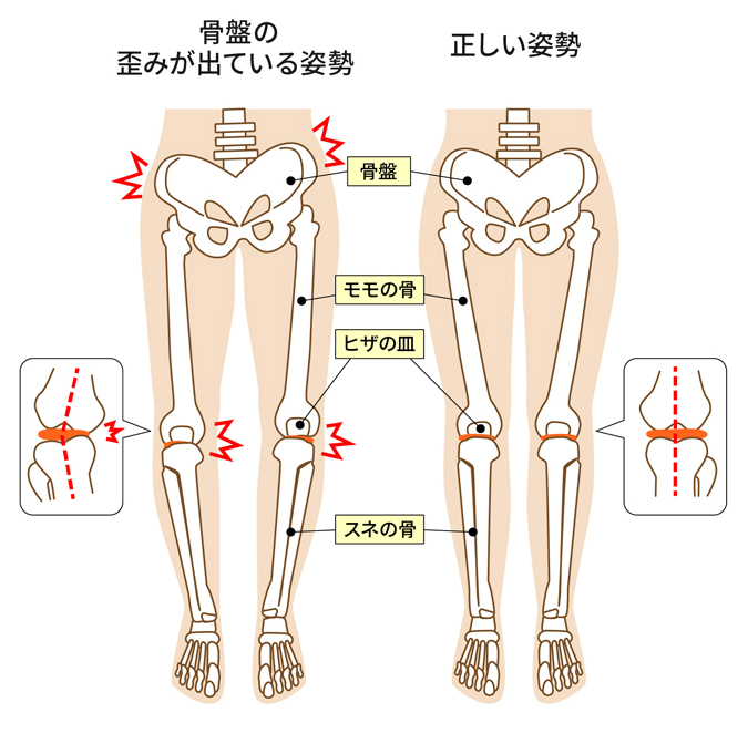 骨盤の歪みが出ている姿勢と正しい姿勢の比較図