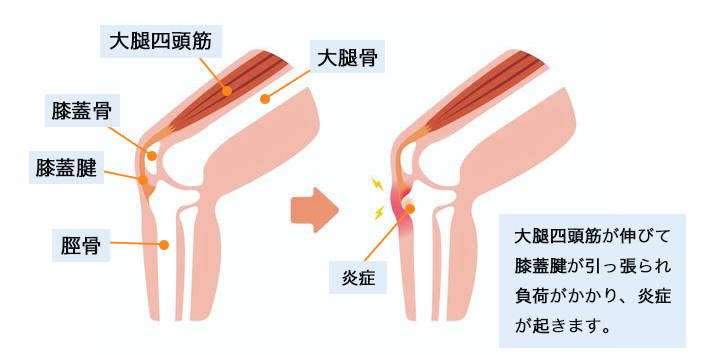 大腿四頭筋が伸びて膝蓋腱が引っ張られ、負荷がかかることで炎症が起きるメカニズム図