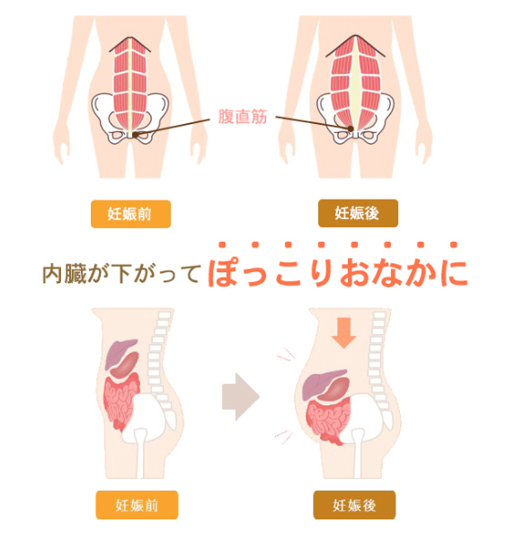 腹筋が裂けて内臓が下がる仕組み