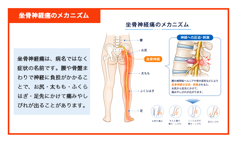 坐骨神経痛に関わる部位のイラスト