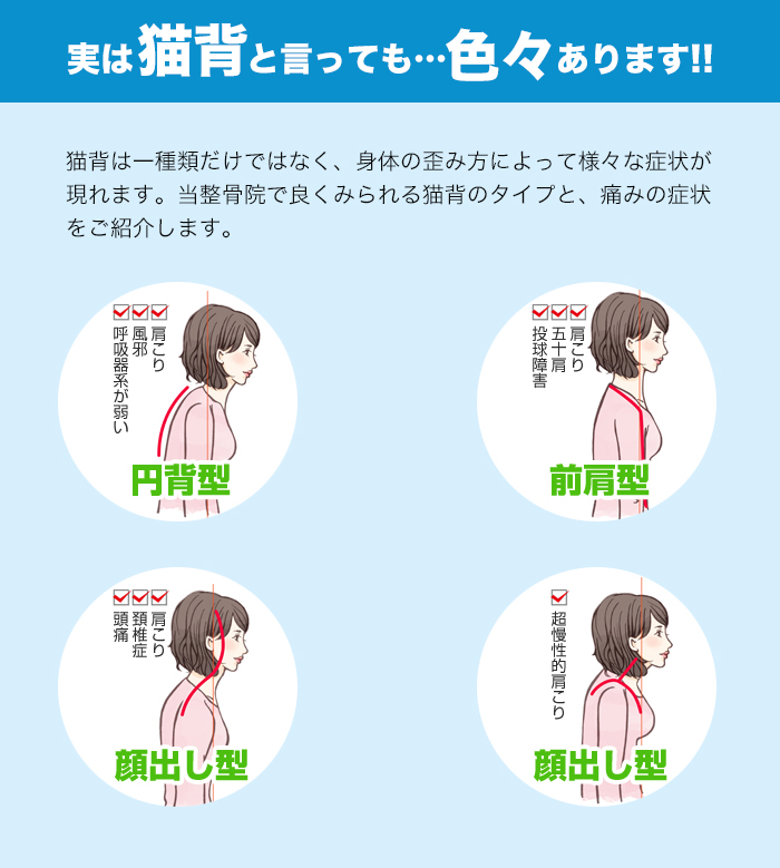 実は猫背といっても色々あります」タイプ別図解
